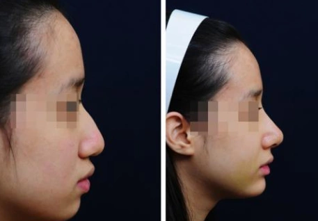 驼峰鼻矫正手术需要注意什么事项