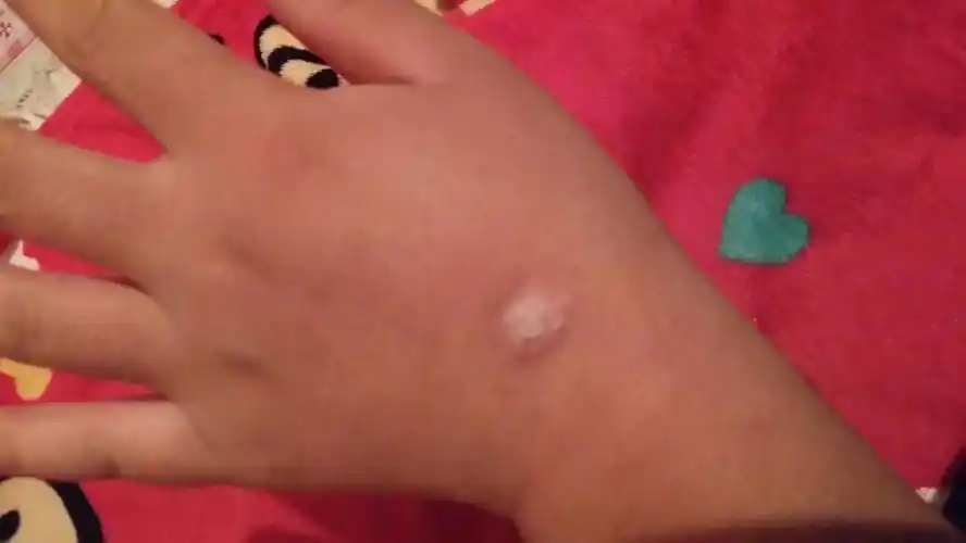 夏天被蚊子咬过,然后就把包抓破了,就成现在这个样子了,咋回事啊?