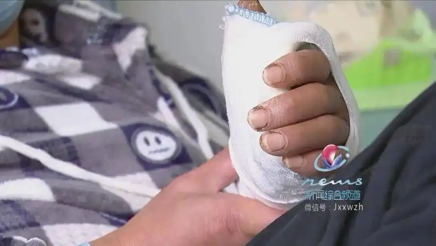 6位医生二十个小时断肢再植还患者一只完整的手掌