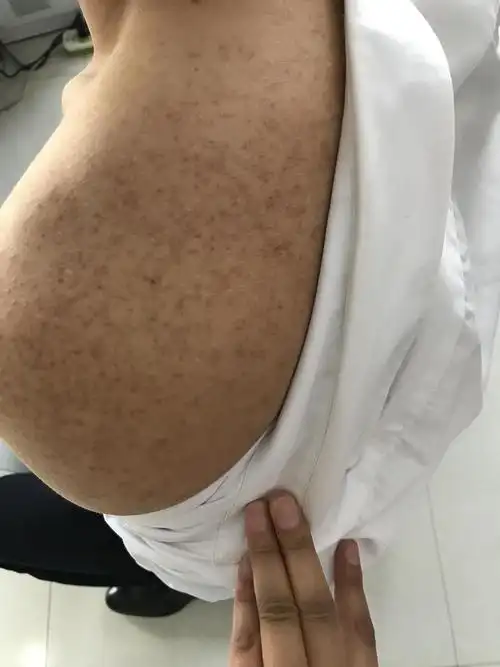 有比我还严重的鸡皮肤嘛 还有没有救