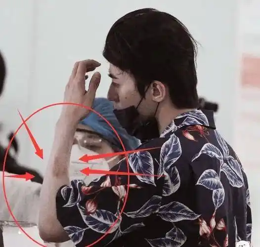 看到蔡徐坤手臂上的淤青,粉丝心疼了_伤口_因为_时候