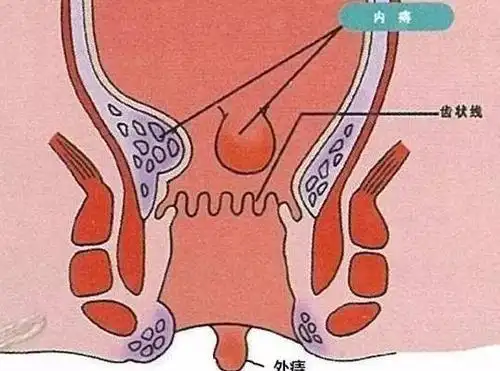 泰斗中医院浅析内痔是什么样的