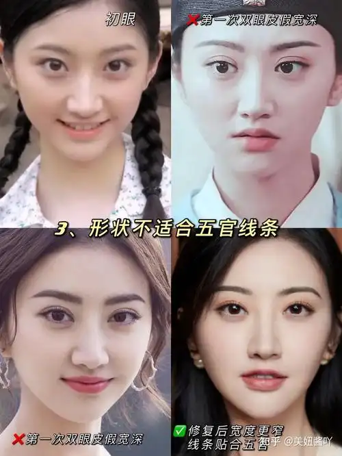 景甜的双眼皮到底是哪个医生修复的? - 知乎