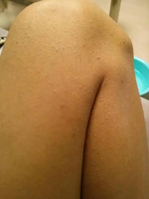 还有许多团成一圈,隔着一层薄薄皮肤被堵住的腿毛,算是毛囊堵塞吗,该