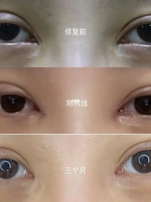 scq包眼角三个月对比_内眼角_疤痕贴_包眼角_美妆_医美整形