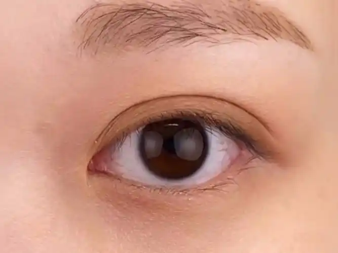 7毫米平行双眼皮