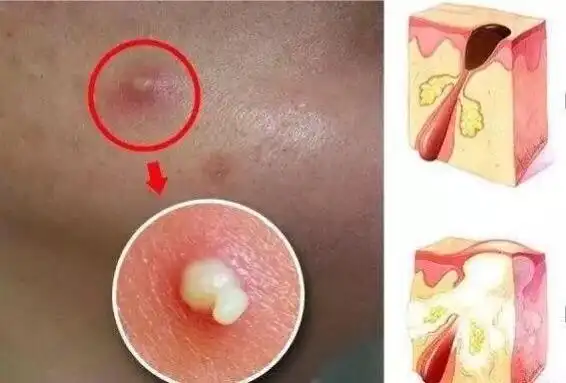 痘痘挤出的白色"小粒粒",到底是什么东西?