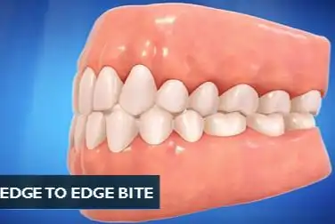 上下前牙对齐的咬合还不够标准吗