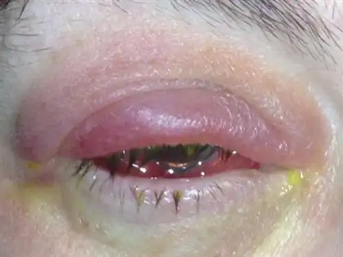 流行性角膜结膜炎