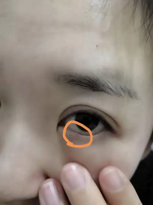 下眼皮长个小点,像小疙瘩似的,有时候磨眼睛,问大神是什么?怎么样除掉