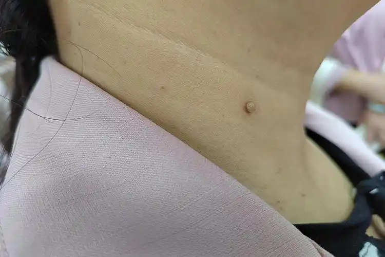 好发于颈,额,眼睑及腋下;发生于头皮及趾间的疣体表面常有参差不齐的