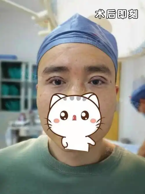 平扇形双眼皮男生款