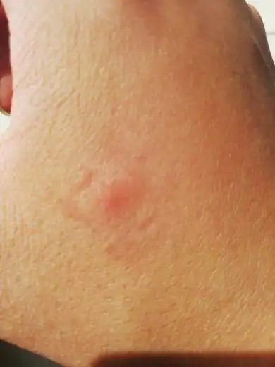 被小黑蜘蛛咬后伤口会疼吗,为什么我感觉不怎么疼?