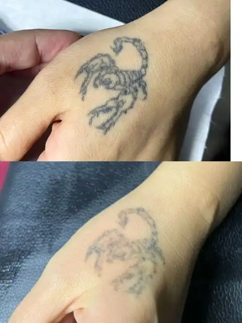 清洗纹身一次效果对比