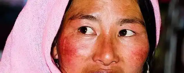 美丽的高原红, 怎么去除红血丝? | 皮肤