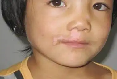 白斑病图片的介绍