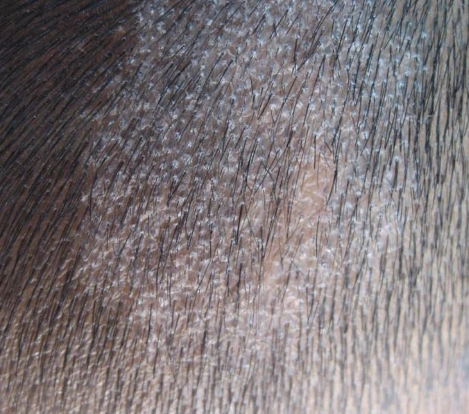 头癣的症状图片 (10)