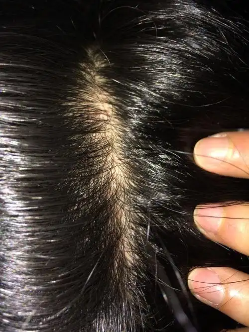 头发发根起小水泡是热症吗?是热症要怎么治疗?