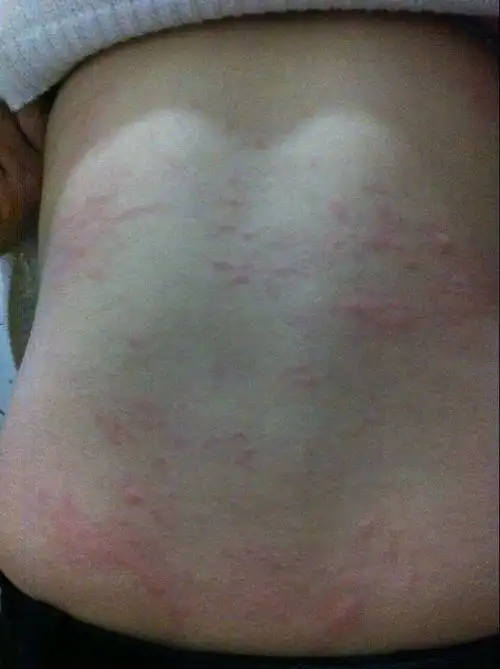 吃芒果过敏,怎么办,很严重