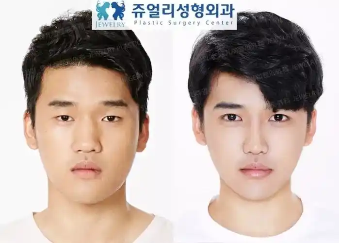 惊艳到爆男士整容前后对比照片