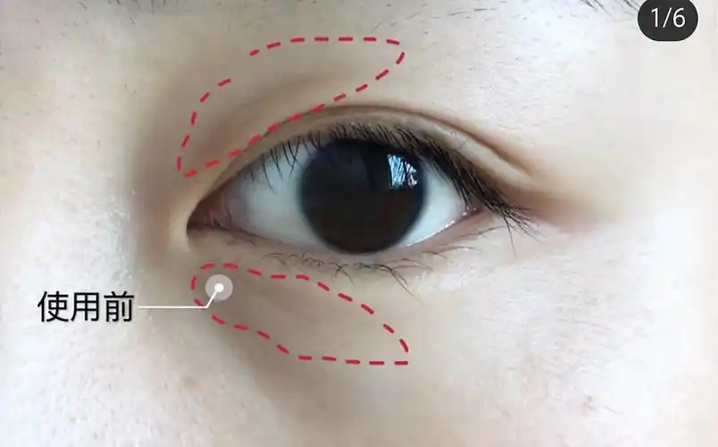 友友们上眼皮这种一条与上眼眶平行的褶皱是啥啊