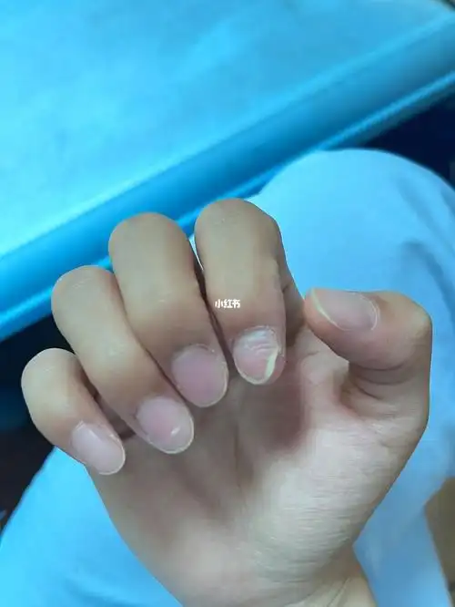 手指甲变成这样是怎么回事