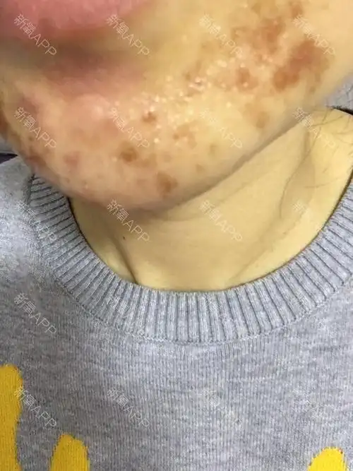 下巴刷了果酸,三天了,越来越严重,不是结痂,能好吗,有什么措施