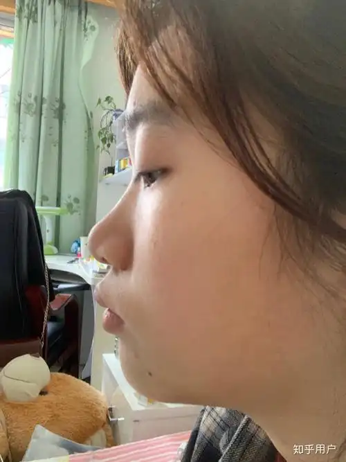 龅牙凸嘴怎么改善侧脸? - 知乎