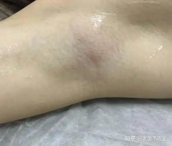 女生怎么脱腋毛有什么靠谱的脱毛膏推荐