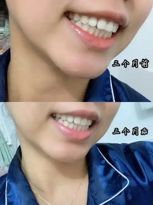 2不觉中带牙套都三个月过去啦,效果也是显现了点,还_圈子-新氧美容