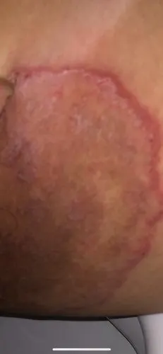 大腿内侧这样很痒.怎么回事?