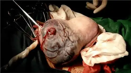 降低凶险性前置胎盘发生的危险因素,如剖宫产史,反复流产史,多次宫腔