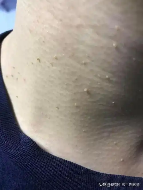 脖子长小肉粒怎么去除?-惠修网