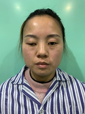 【讨论】重度上睑下垂矫正术 - 修复重建和烧伤整形