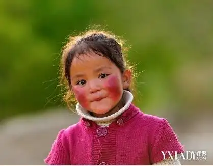 【图】高原红怎么去除脸上的红色 三个简单的方法还你光滑肌肤