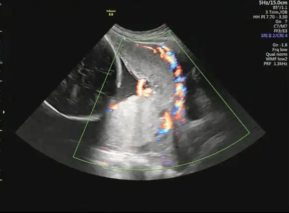 罕见高危孕妇前置胎盘合并胎盘植入医生妙手保子宫