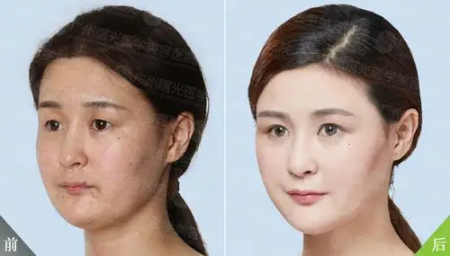 大三学生自体脂肪丰全面部前后对比(组图)