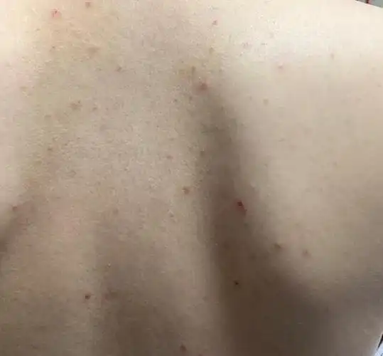 后背上都是痘痘,那是啥?再次提醒:别把毛囊炎当成普通的痘痘