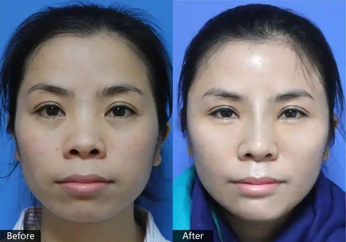 自体脂肪填充改善的不止是容貌