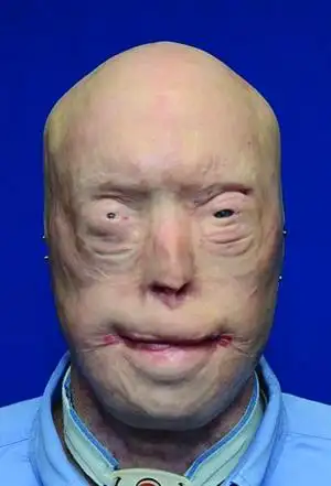 美国消防员多年前因救火毁容成功接受换脸手术