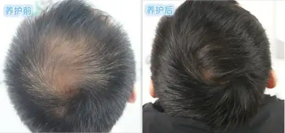 头发变得稀疏细软怎么办?