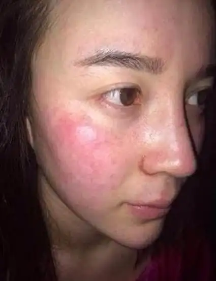 韩之媚|红血丝敏感肌肤如何修复?正确修复方法大公开_皮肤