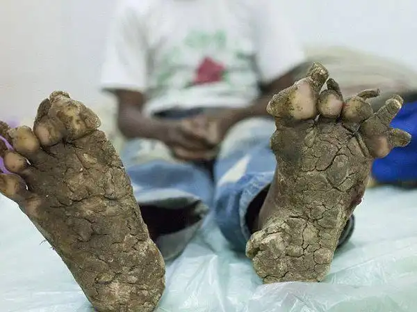 近日,一个孟加拉家庭中的父亲,叔叔和儿子均患上罕见的遗传皮肤病