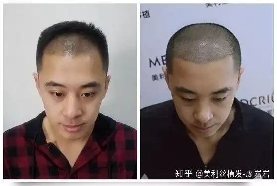 董轩凯植发前后对比