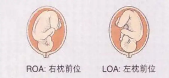 loa胎位和roa胎位哪个好