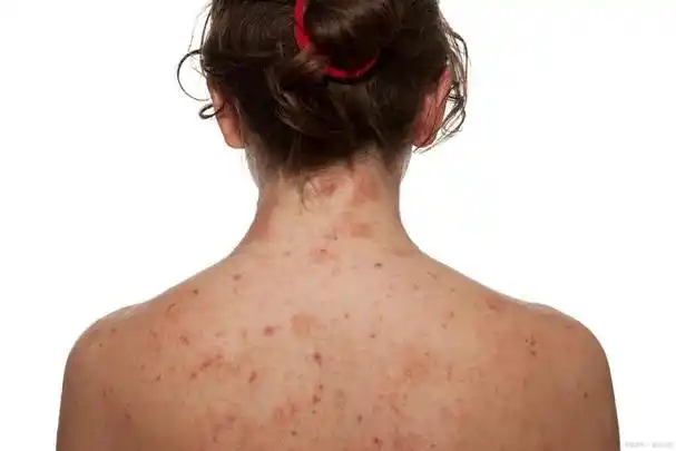 背部反复长痘?要注意,可能是毛囊炎发作!
