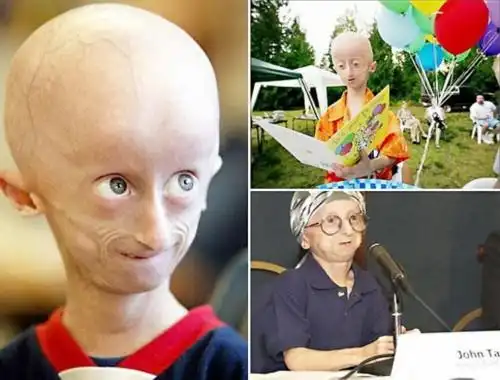 首页 养生图库 奇闻 大千世界    历数全球最神奇恐怖的十大怪病