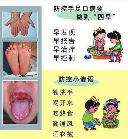 关于手足口病与疱疹性咽峡炎高发期的注意事项
