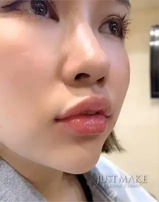 微笑嘟嘟唇注射-w 微笑曲线立即拥有!