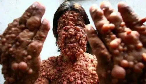 超恶心的密集恐惧症图片大全密集测试图欢迎挑战慎入2